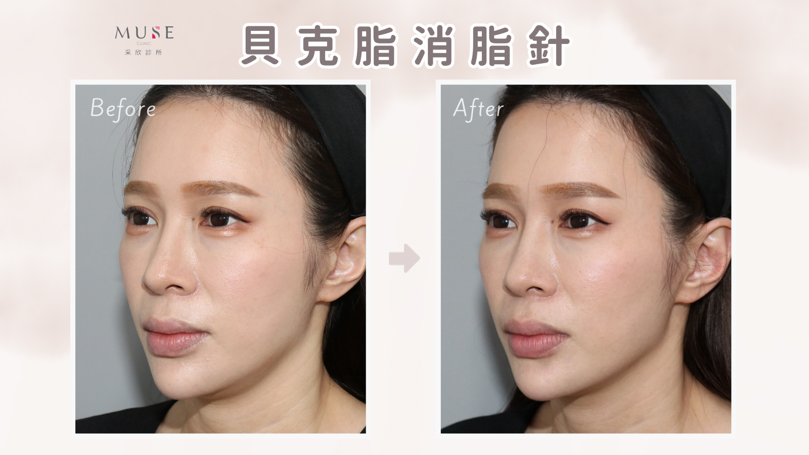 鈴鈴-貝克脂 (1).png